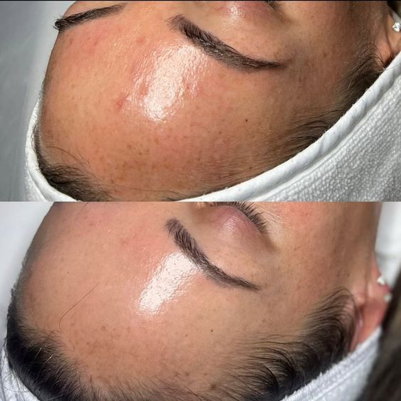 Комбинированная чистка лица/пилинг биорепил