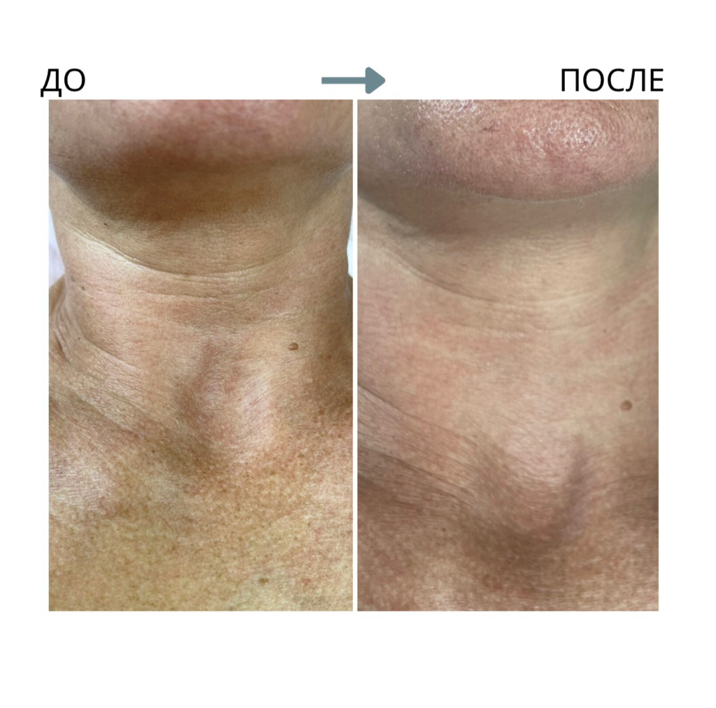 Коллагенотерапия