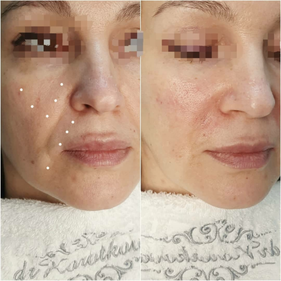 Скульптуризация лица Dermalax (Южная Корея)