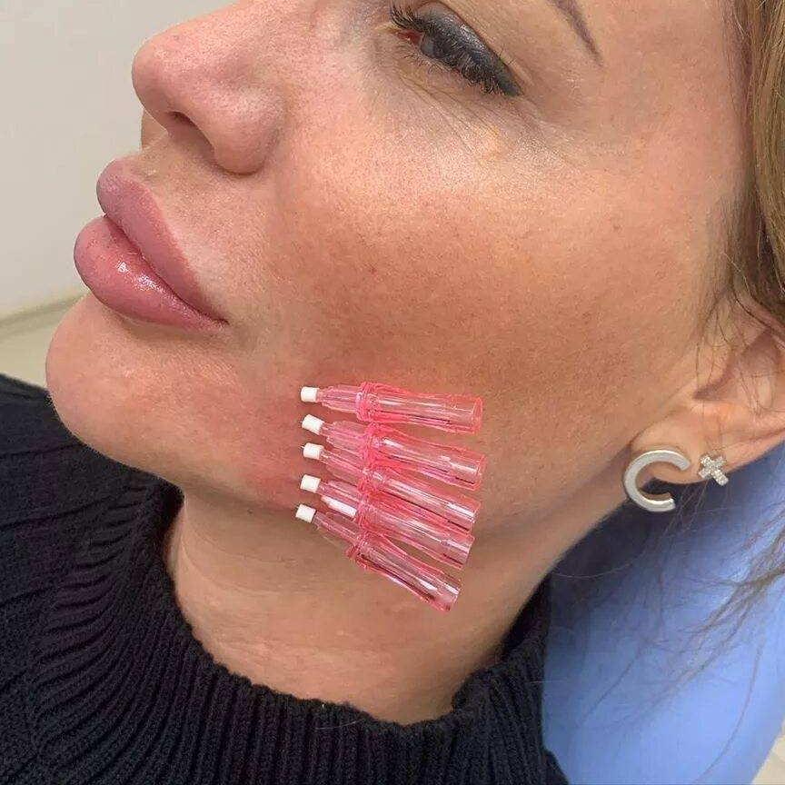 Нитевой лифтинг 10шт.