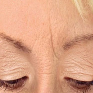 Коррекция рубцов/глубоких заломов