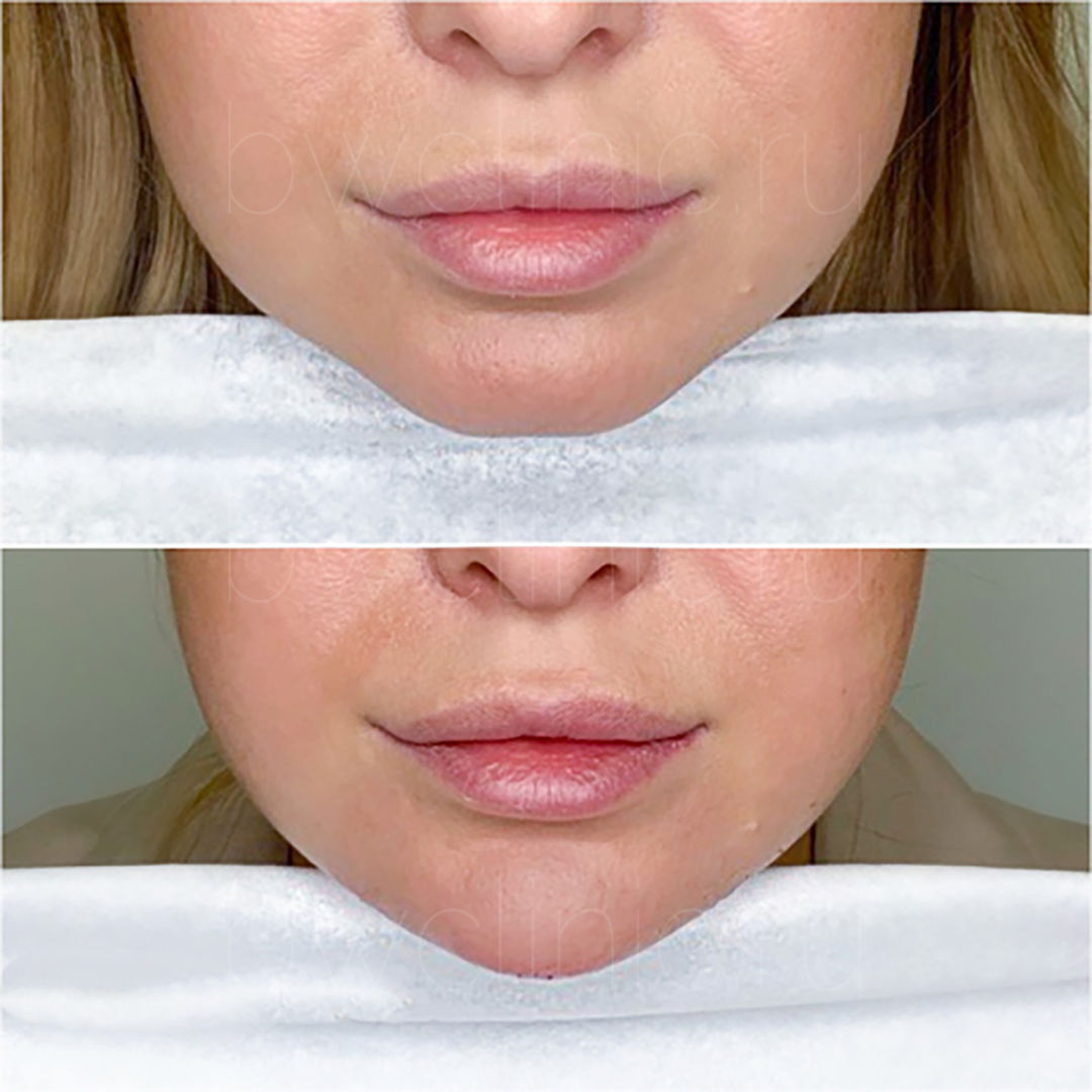 Контурная пластика подбородка Dermalax (Южная Корея)