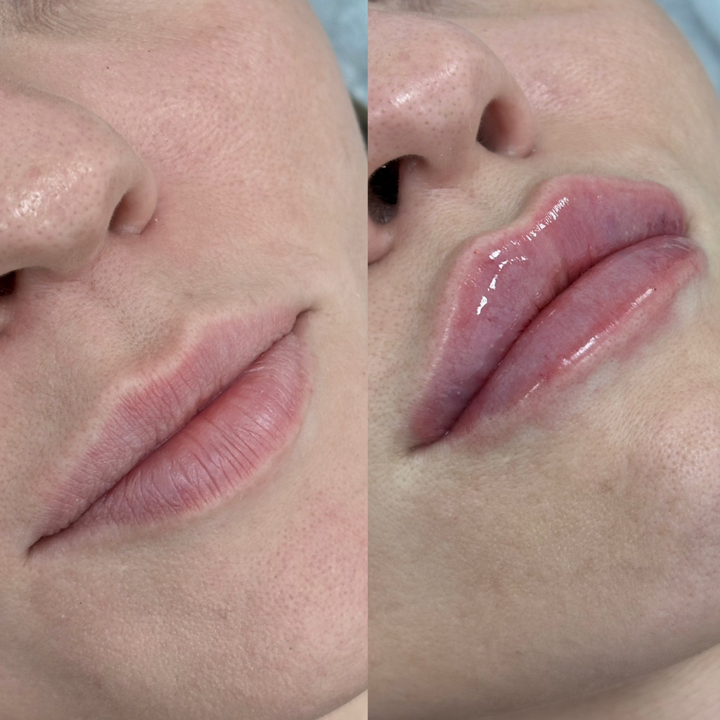 Увеличение губ