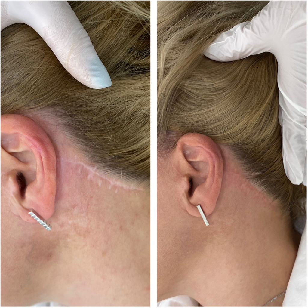 Камуфляж шрамов после круговой подтяжки лица