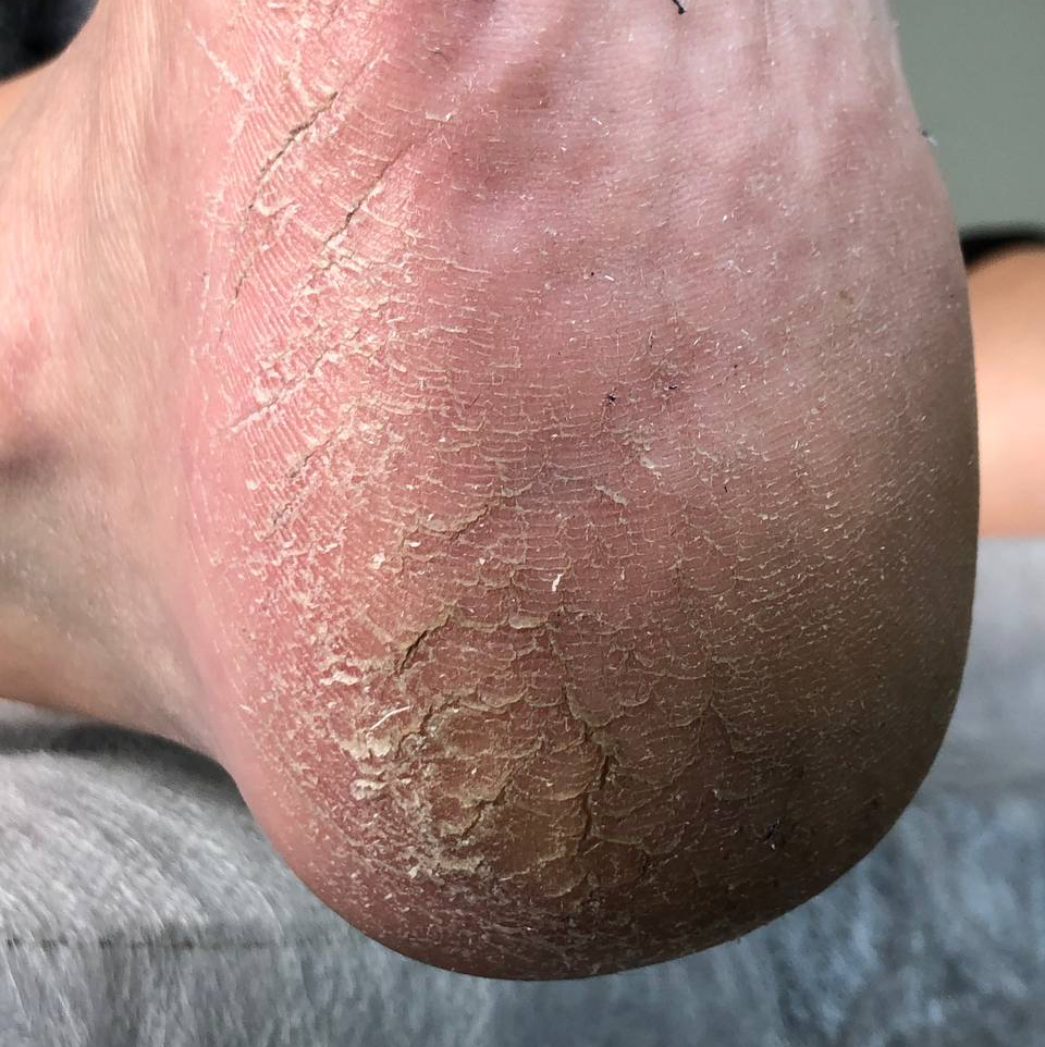 Педикюр 1 категории  обработка стоп и ногтей средней сложности (онихолизис, утолщение НП, мозоли, гиперкератоз)