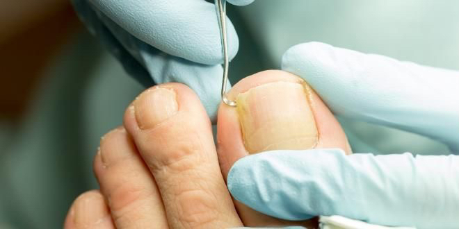 Обробка оніхолізису (1 палець) — 500 крон