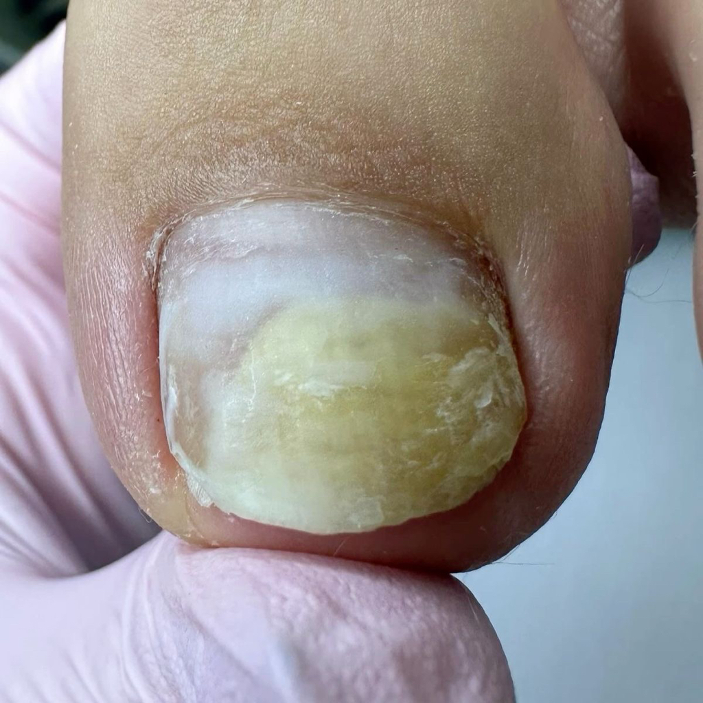 Обробка проблемних та дистрофічних нігтів (одна нога) – 600–800 грн  Послуга включає: 	•	Зачистку потовщених та деформованих нігтів 	•	Лікування грибк