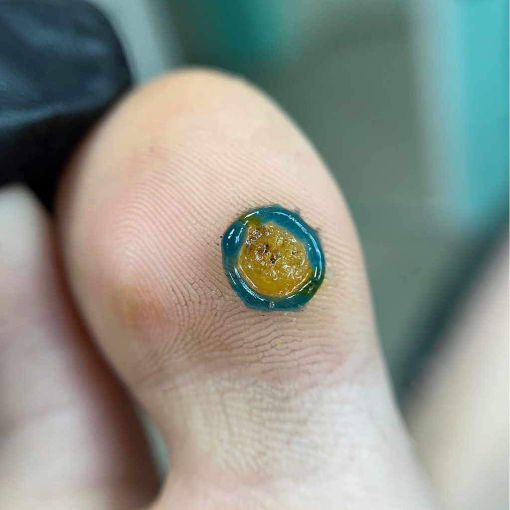 Обробка бородавок – від 1000 грн 	•	Перший прийом – 1000 грн 	•	Подальший прийом – 500 грн за одну бородавку 	•	Процедура включає припікання бородавки