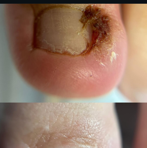 Обробка врослого нігтя (будь-якої складності) – 1000 грн (перший прийом)  Послуга включає: 	•	Лікування врослого нігтя будь-якої складності 	•	Консуль