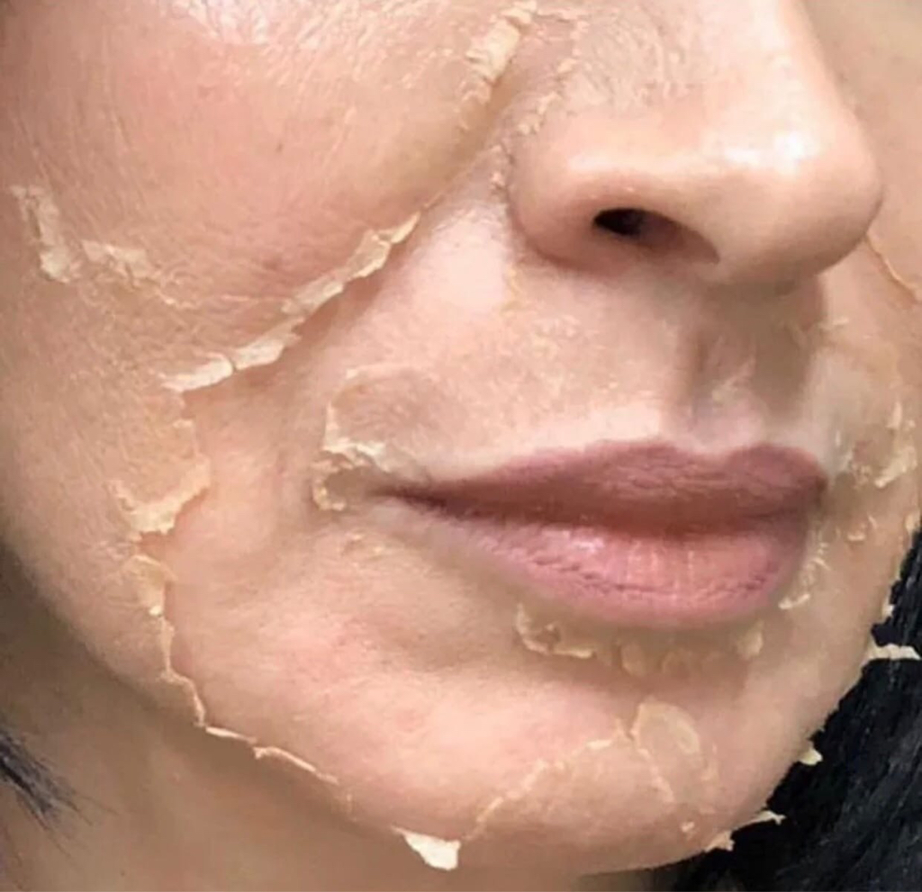 ПИЛИНГ ДЖЕССНЕРА