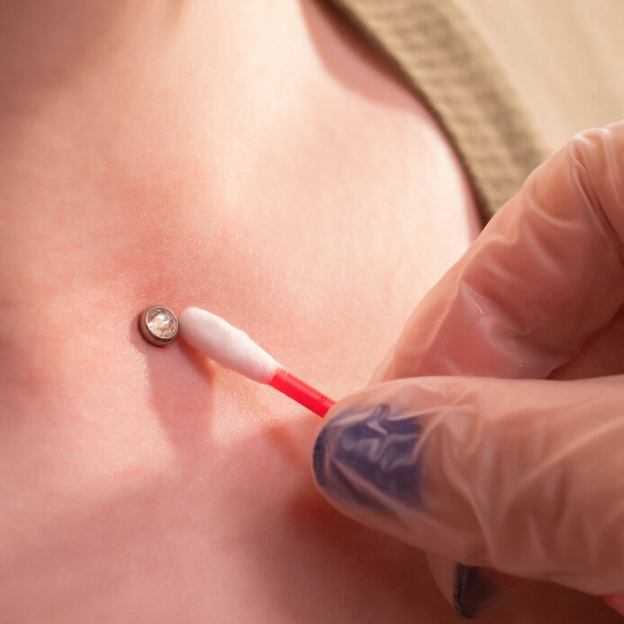 Чистка микродермала