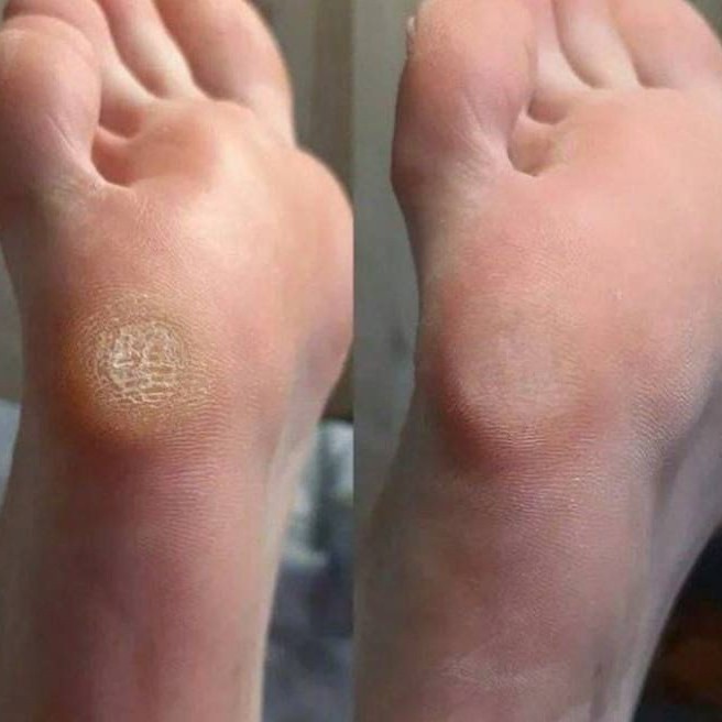 Обработка проблемных участков