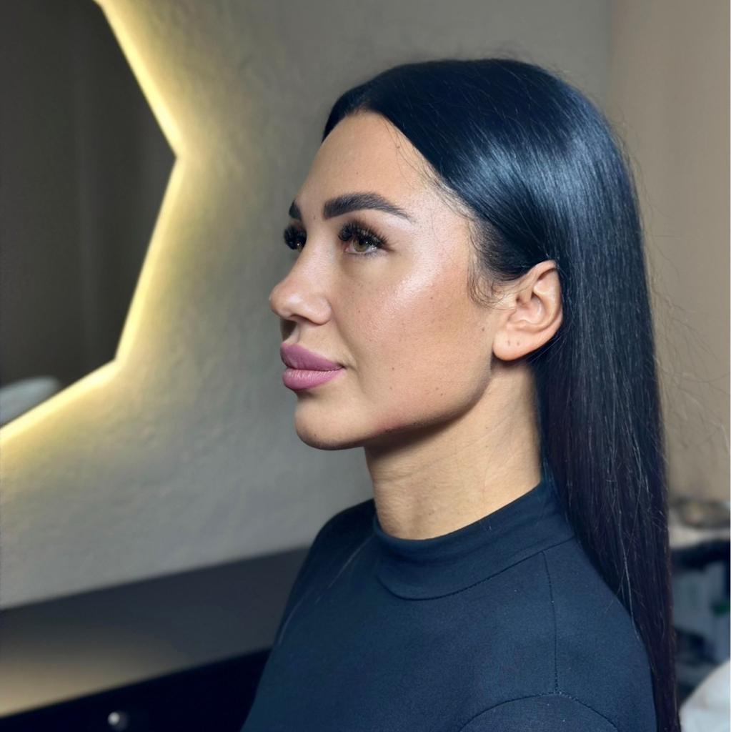 Пластика углов челюсти