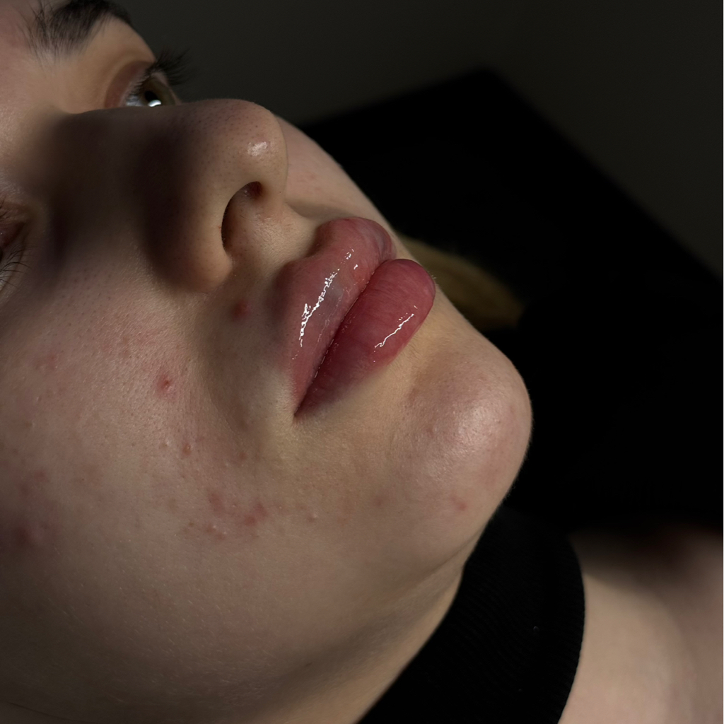 Увеличение губ