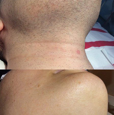 лазерная коррекция бороды полностью