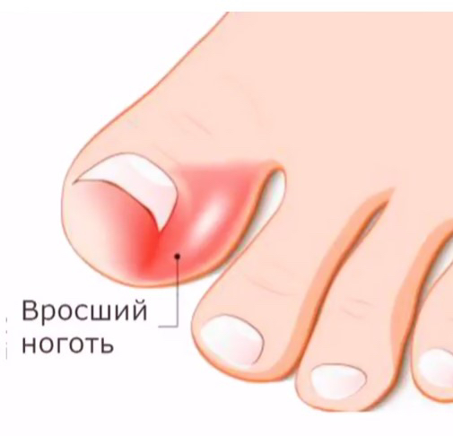 Эстетическая обработка вросшего сегмента ногтя ( l степень)