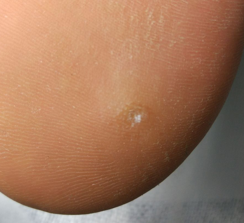 Аппаратная обработка стержневой мозоли