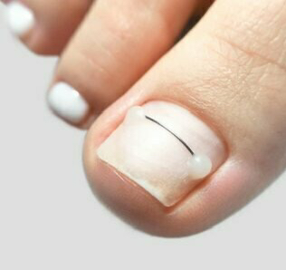 Коррекция вросшего ногтя системой «Титановая нить» (I пальцы)