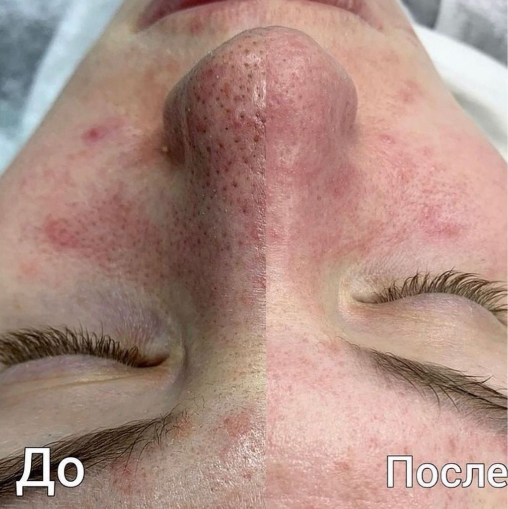 Чистка лица