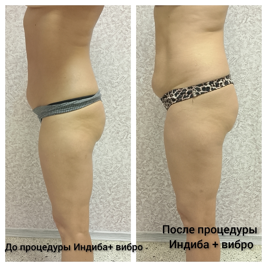 INDIBA - тело