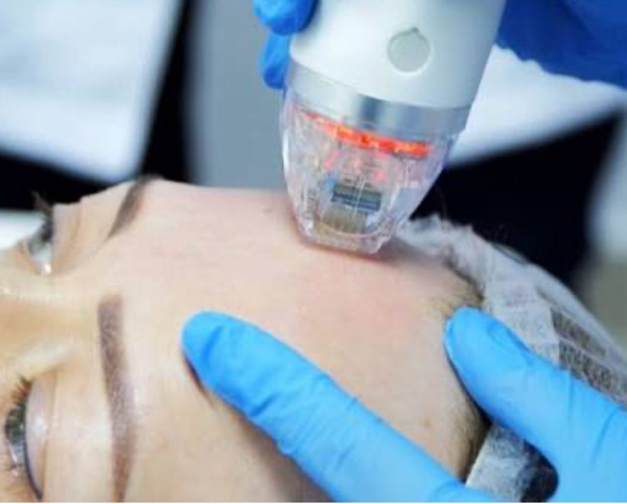 Микроигольчатый PF- лифтинг/ фракционный (лицо)