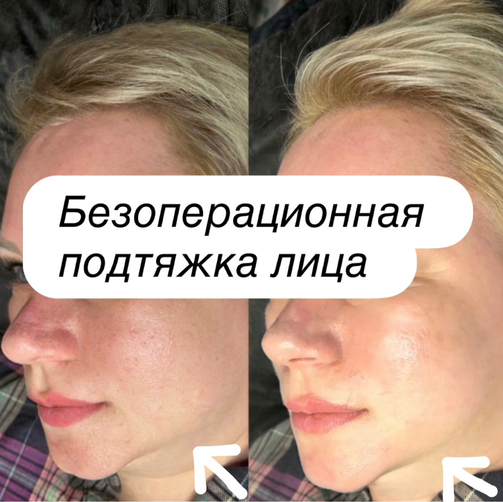 Смас лифтинг (SMAS лифтинг) лицо 500 линий