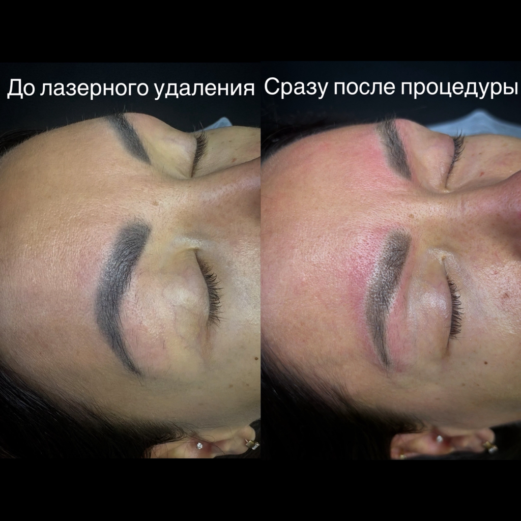 Удаление пм бровей/ тату на теле