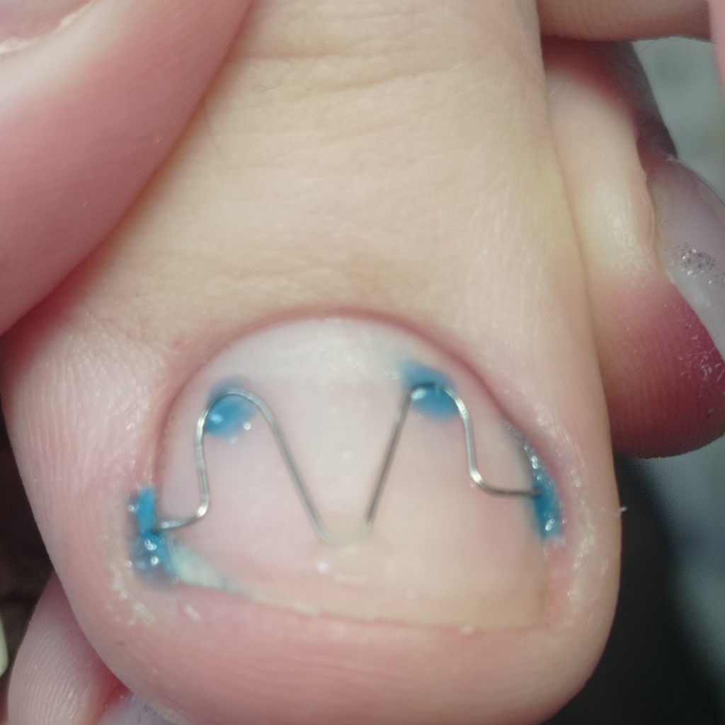 Фиксация корректирующей системы 