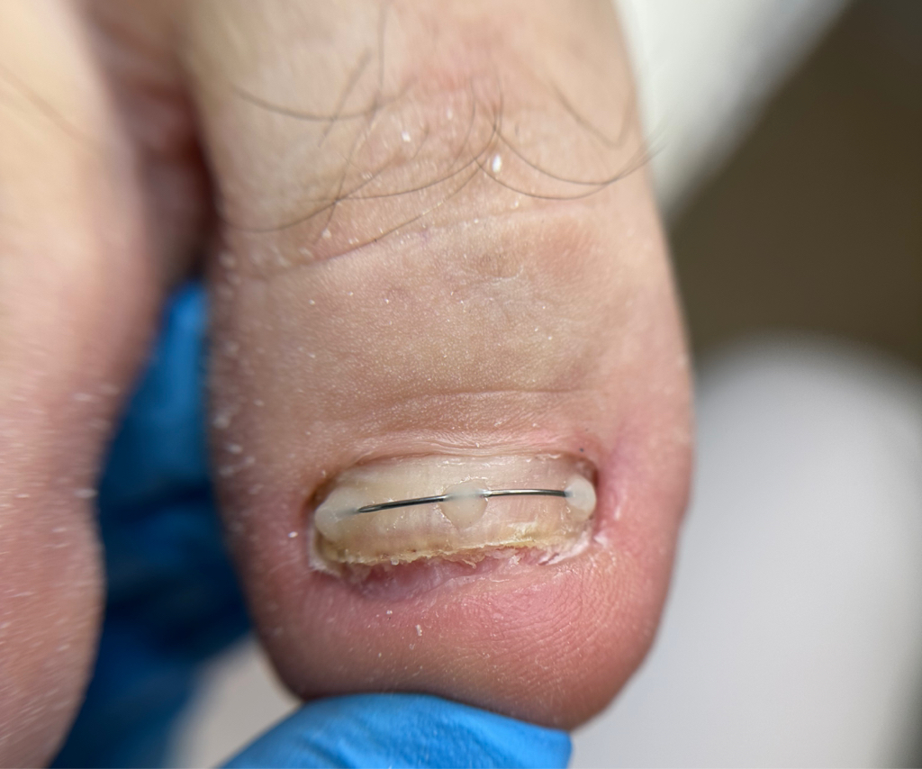 Установка титановой нити