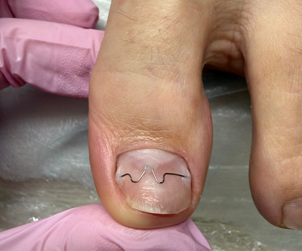 Коррекционная система M-brace