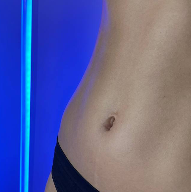 Лазерная эпиляция - живот