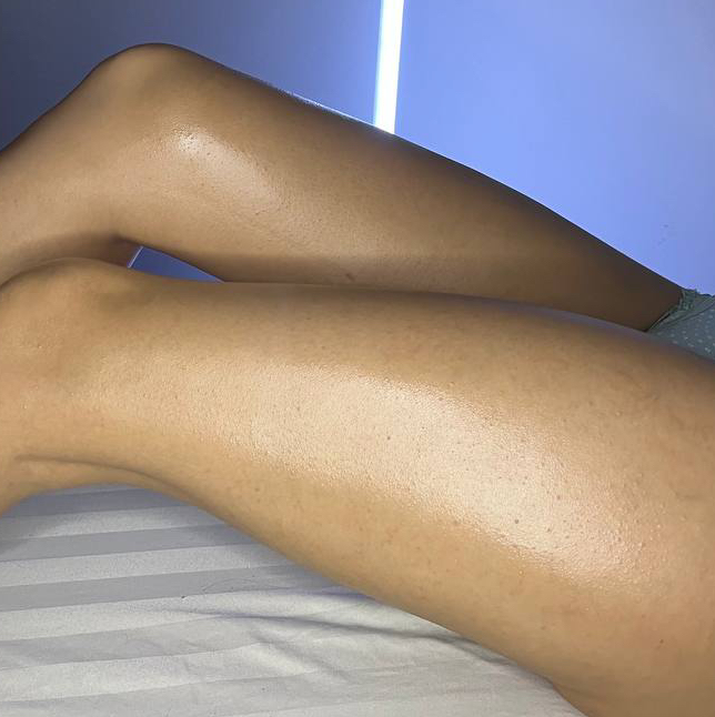 Лазерная эпиляция - бедра