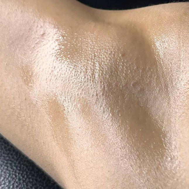 Лазерная эпиляция - подмышки