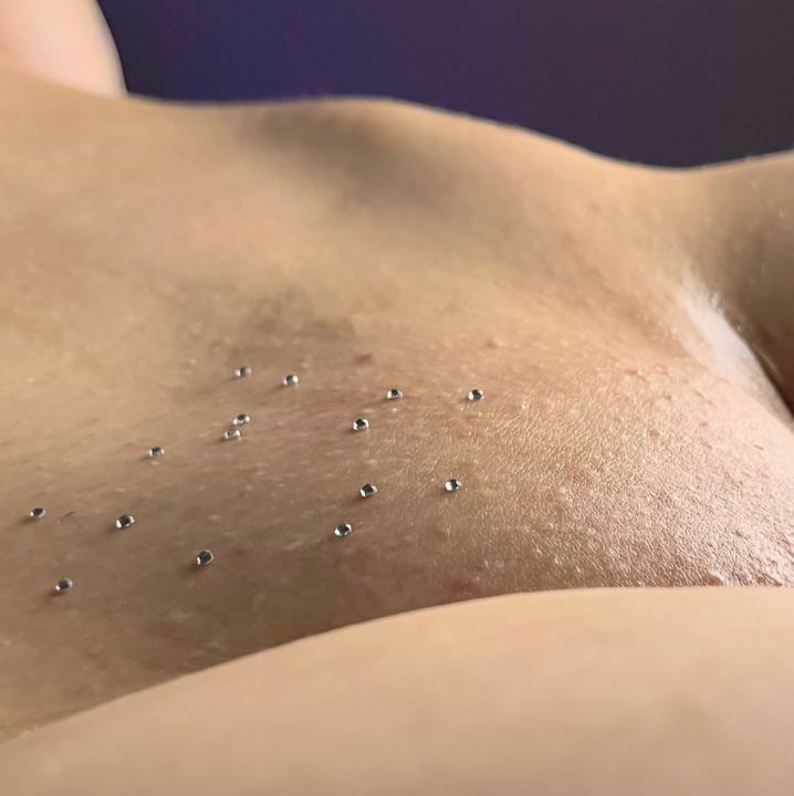 Лазерная эпиляция - глубокое бикини