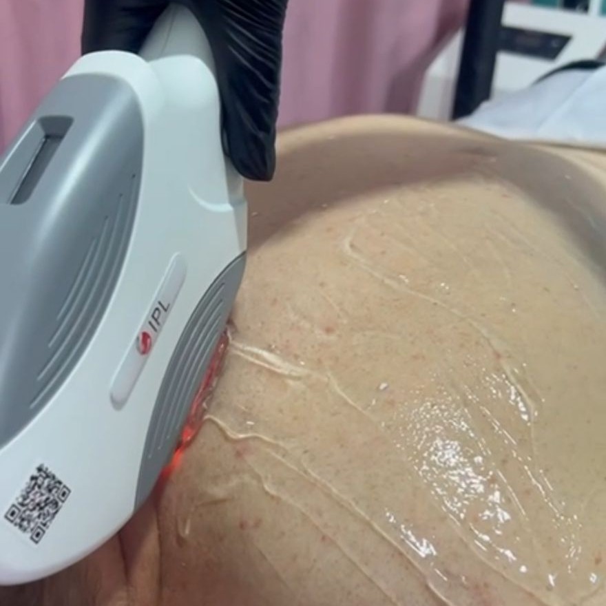 Элос эпиляция зона подмышек