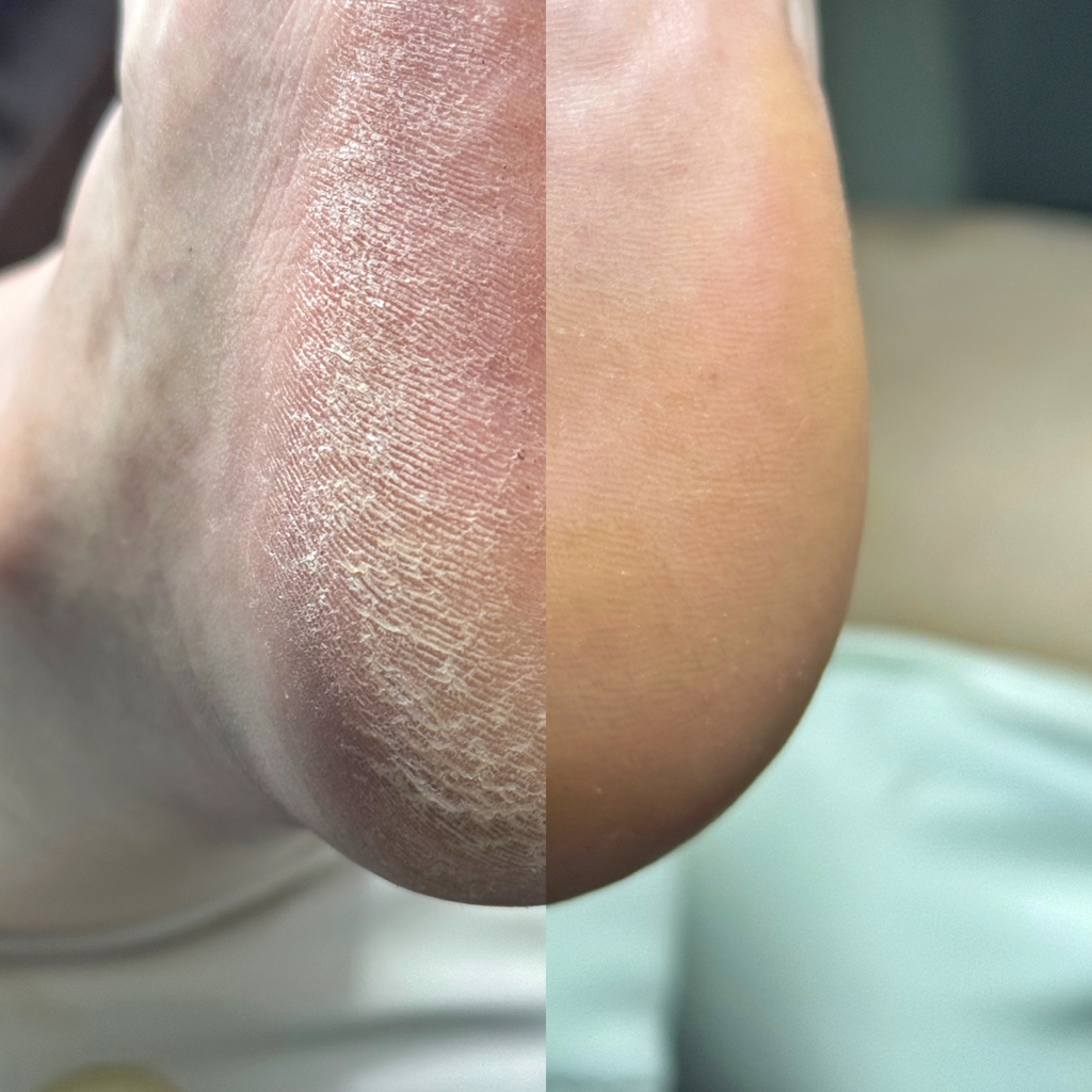 Обработка пяток