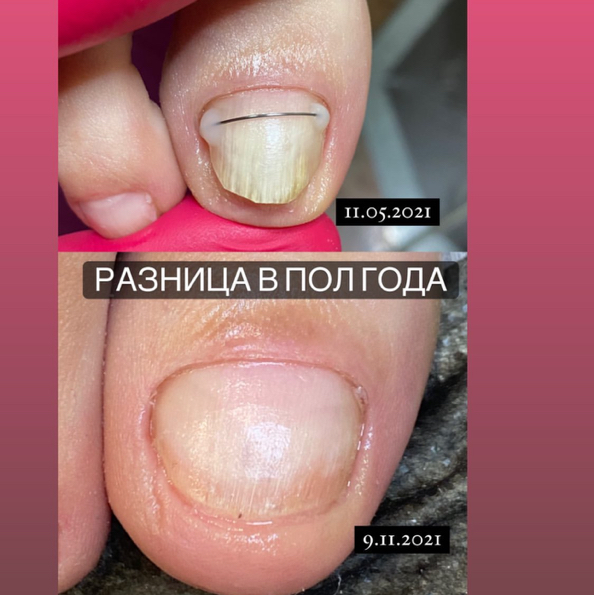 Лечение вросших ногтей