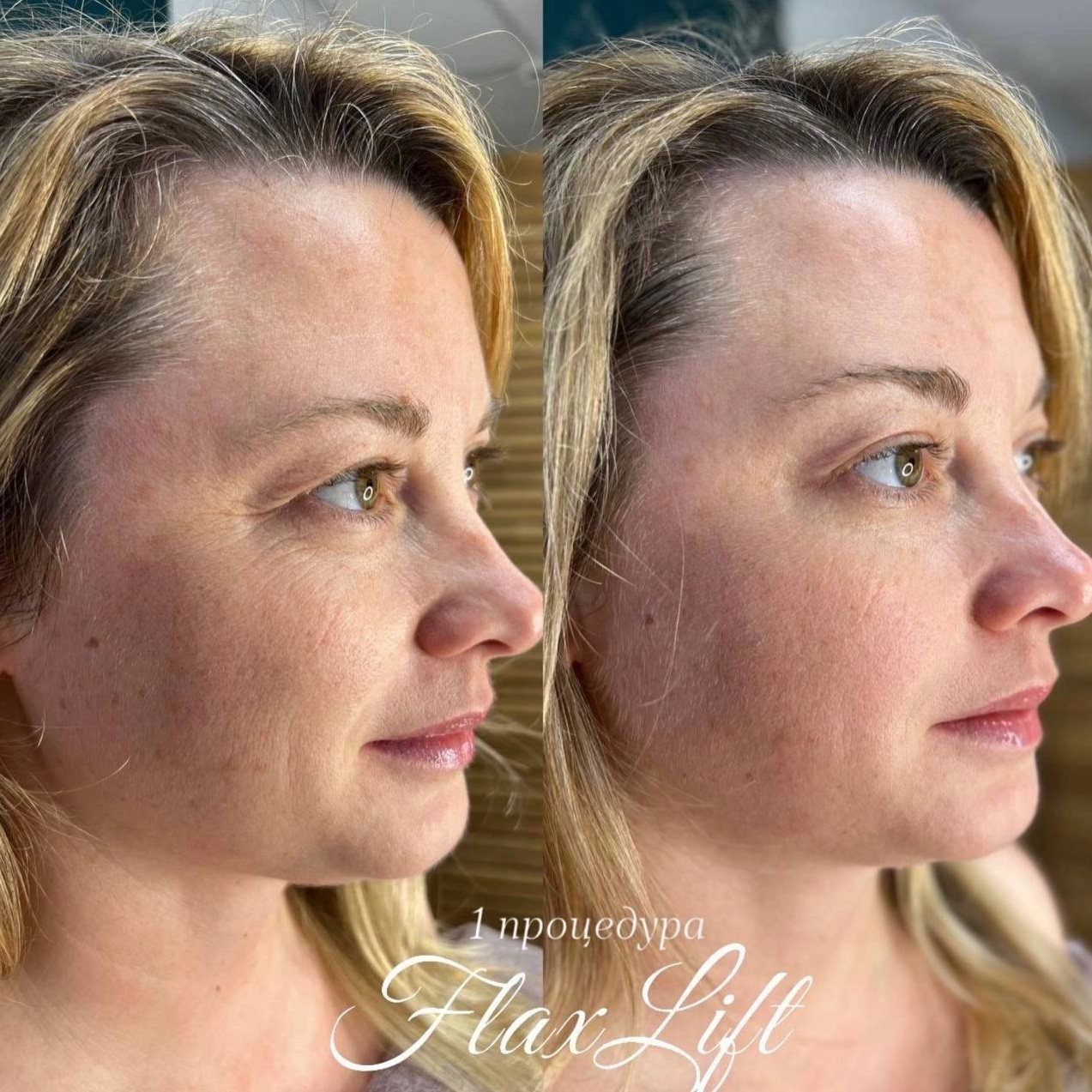 FlaxLift (восстановление тонуса кожи)