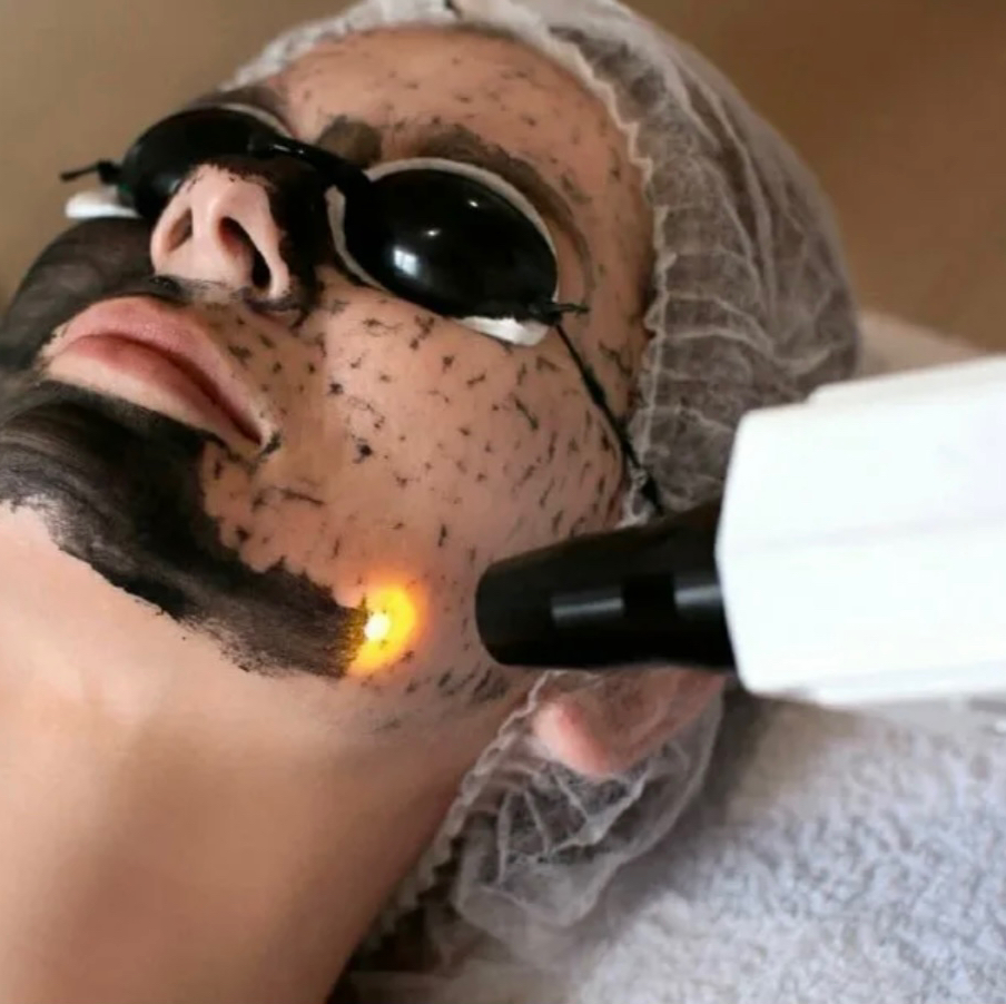 Карбоновый пилинг