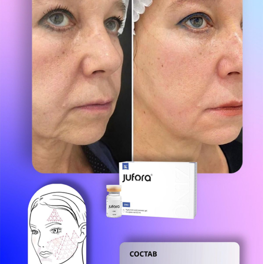 Биоревитализация Юфора