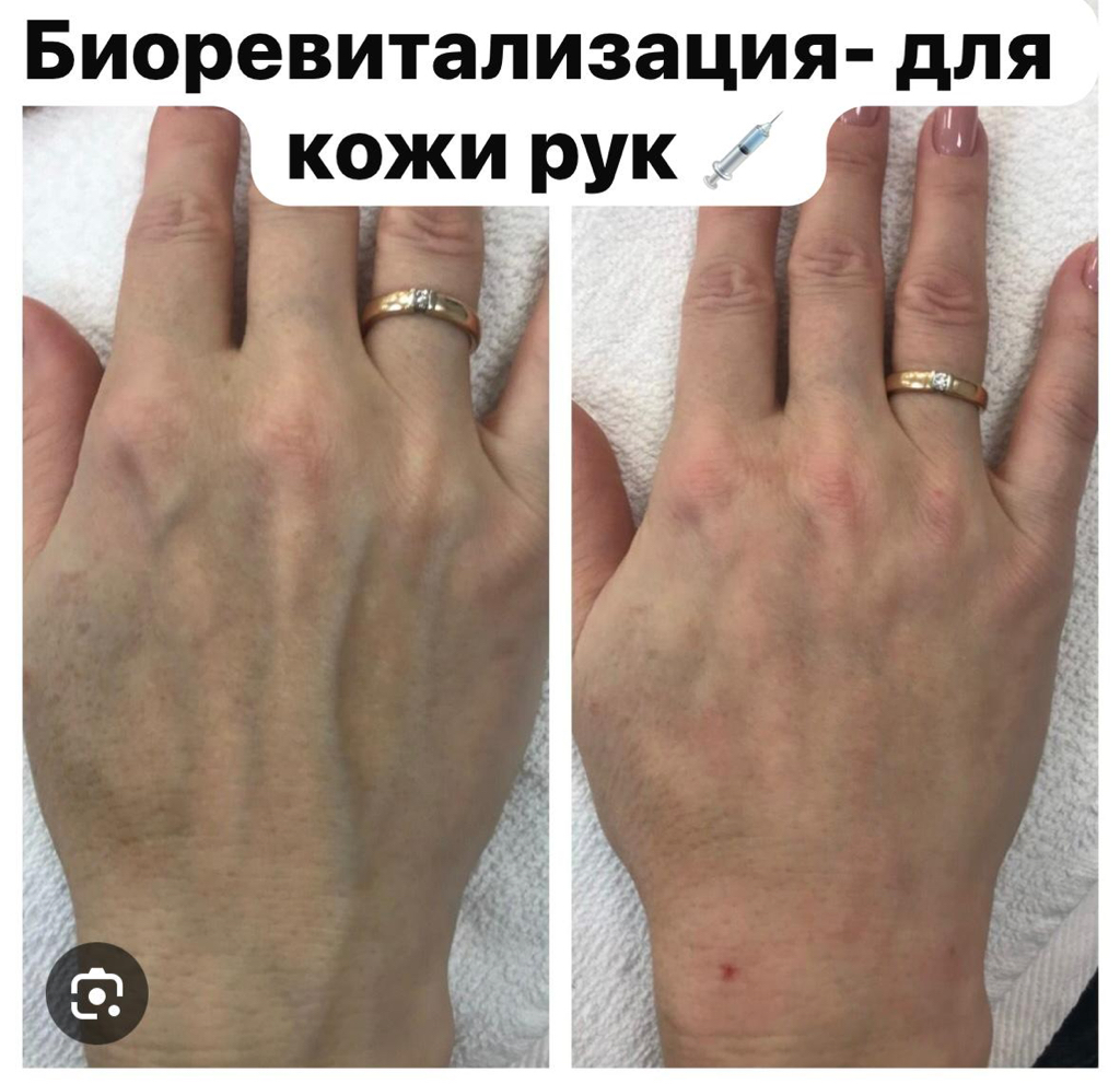 Биоревитализация  для кисти рук 3.мл