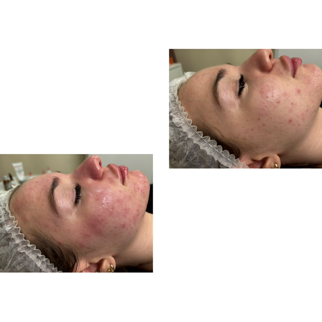 Мезотерапия ZINk 2,0 мл