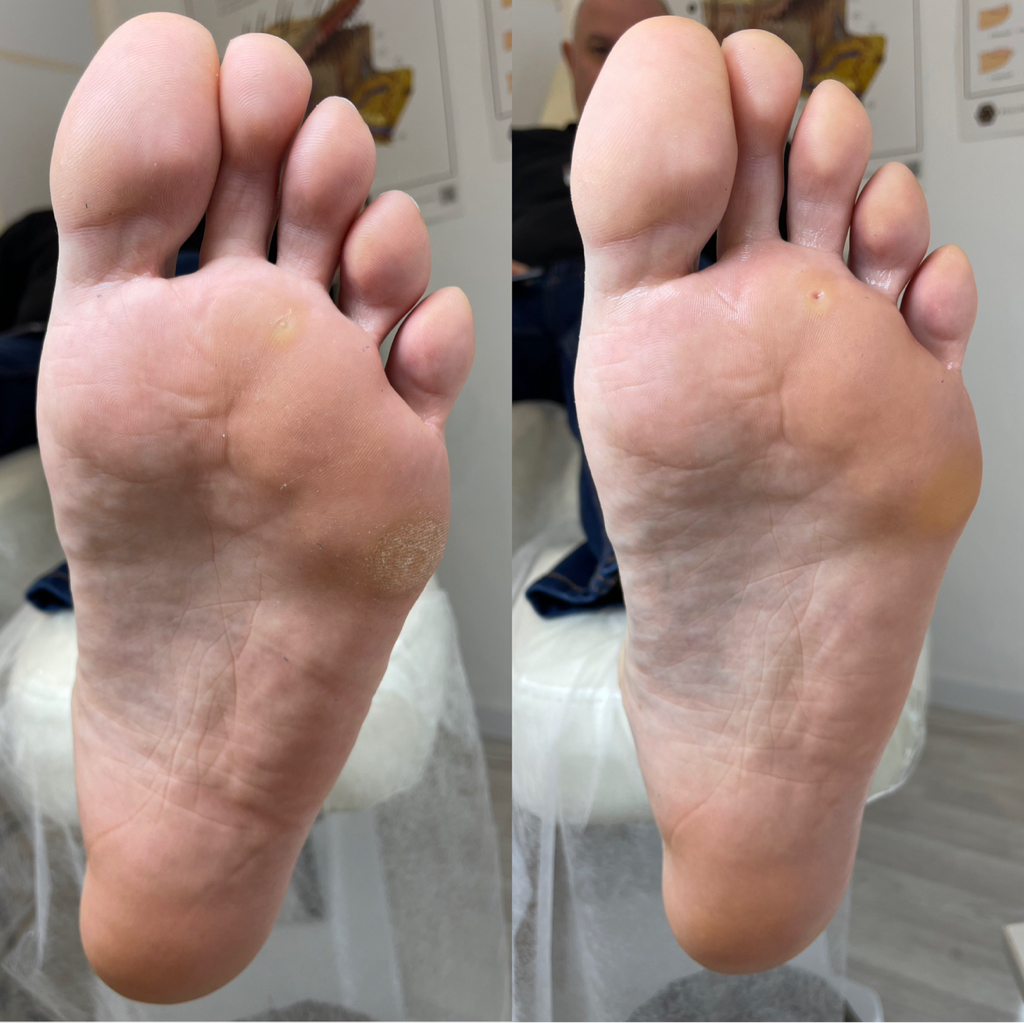 Аппаратная обработка стоп