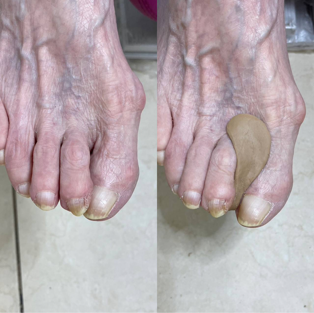 Индивидуальный ортез