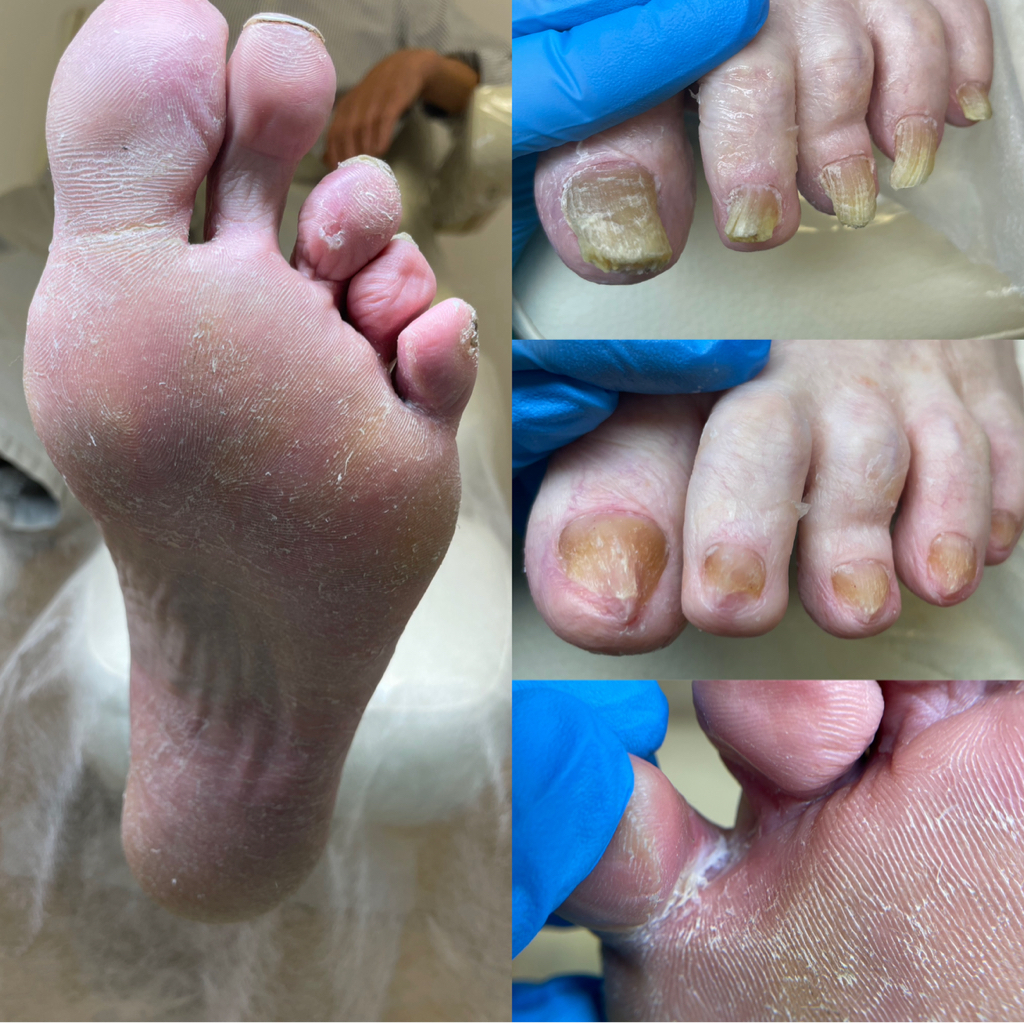 Аппаратная обработка стоп и ногтей (3 степень сложности)