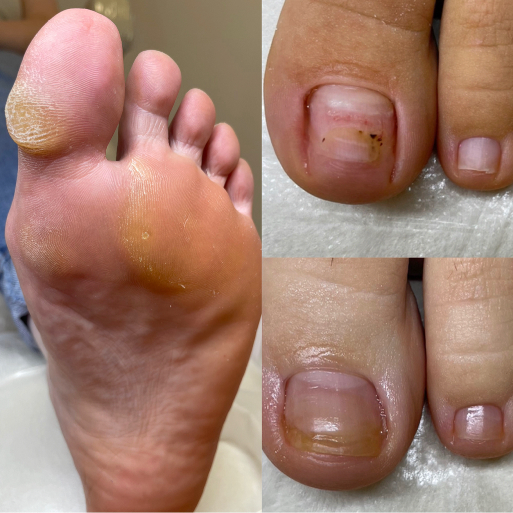 Аппаратная обработка стоп и ногтей (2 степень сложности)