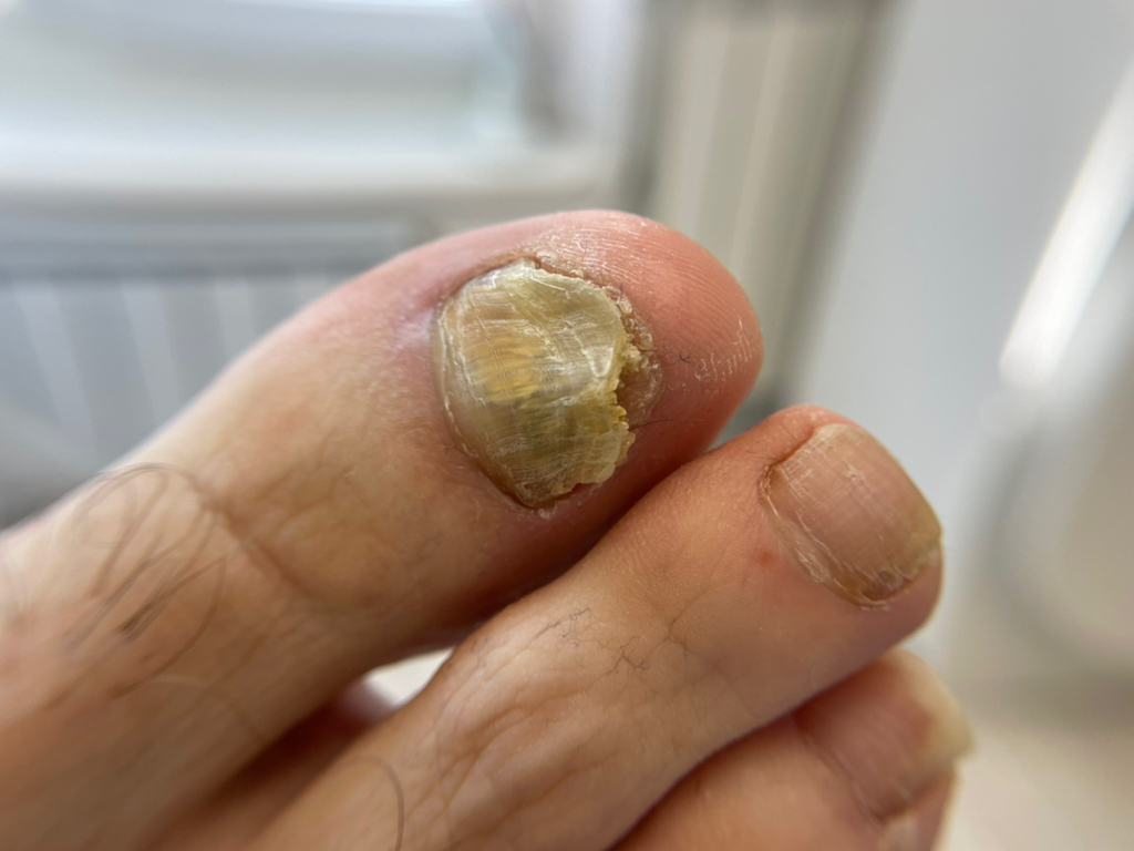 Обработка видоизмененного ногтя (первичный визит)