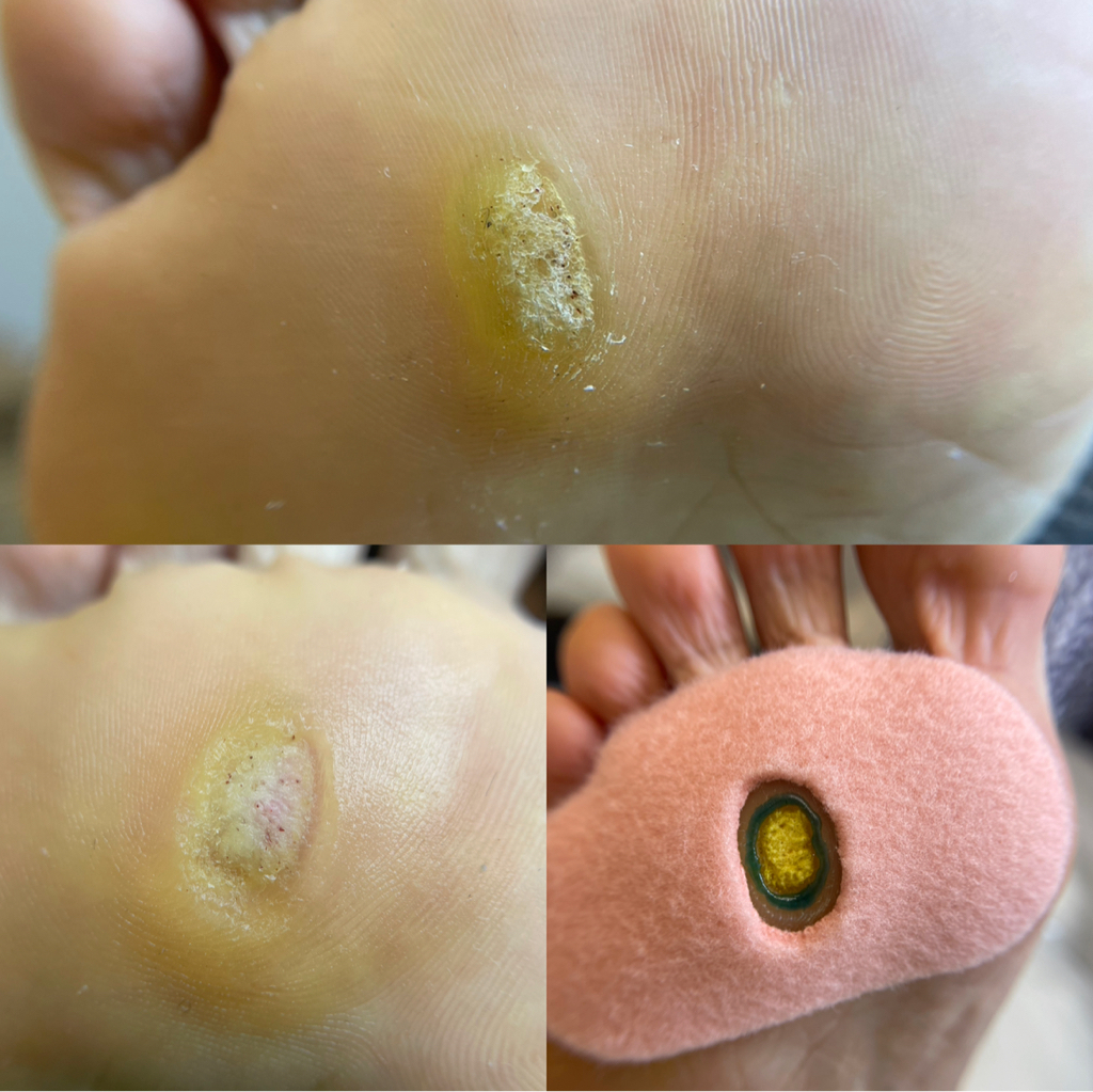 Обработка бородавки