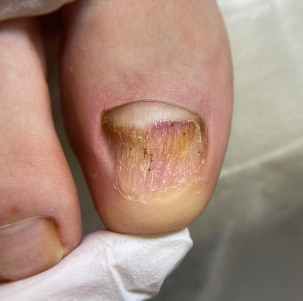 Обработка видоизмененного ногтя (вторичный визит)