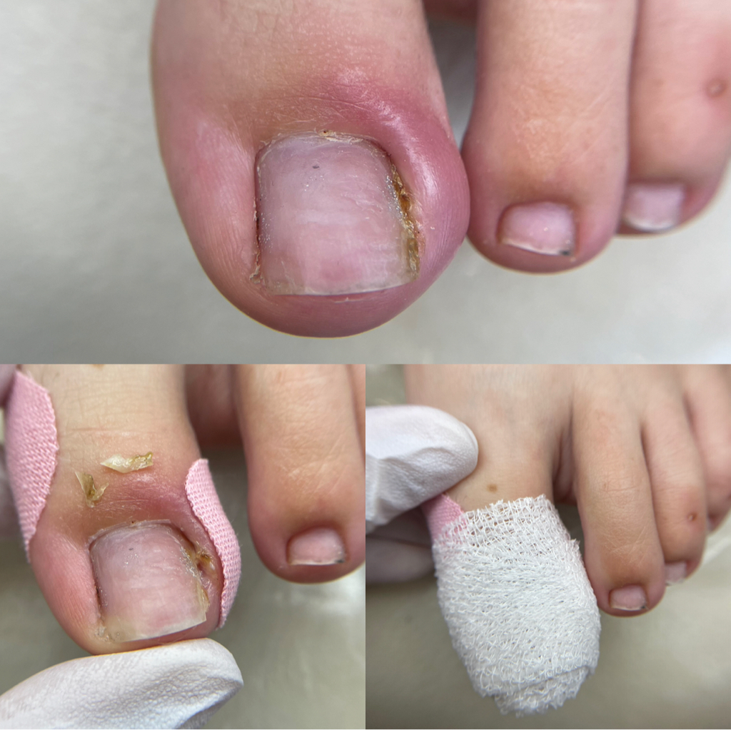 Обработка вросшего ногтя (ll стадия)     Покраснение и отёк, гной